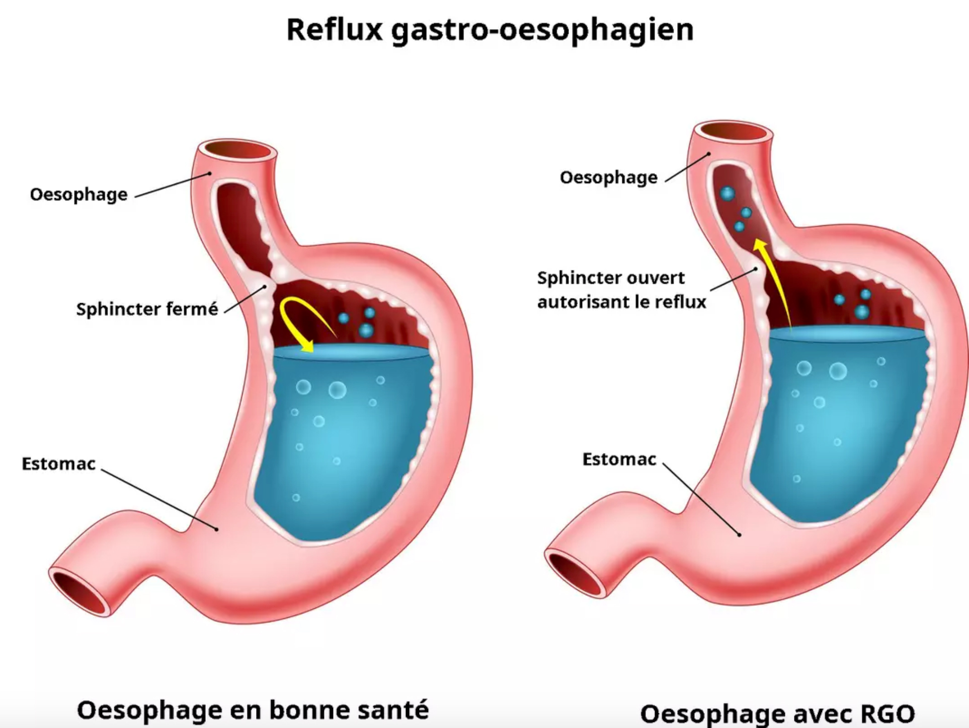 Le reflux gastro-œsophagien (RGO) - Consultation DR Juan AMARIS spécialiste gastro-enterologie